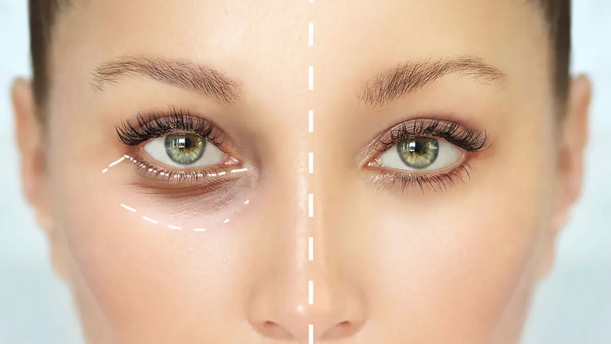 خدمات بلفاروپلاستی در تهران اندرزگو